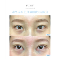 蝶羽整形内眼角到底要不要开