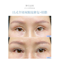 眼窝填脂宽降窄能改善眼部老态