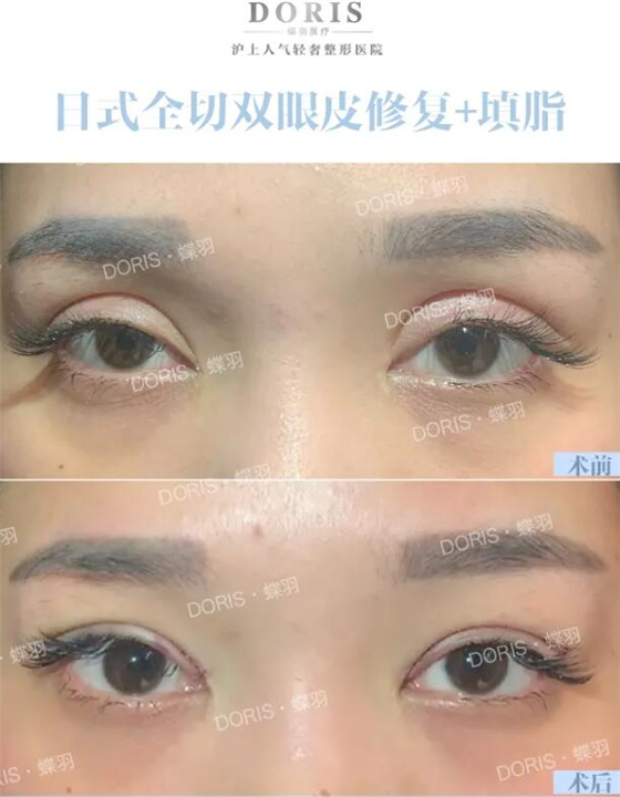 凹陷型的双眼皮想要宽窄一定要填坑吗