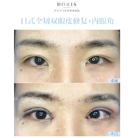埋线双眼皮失败一定要切开修复吗