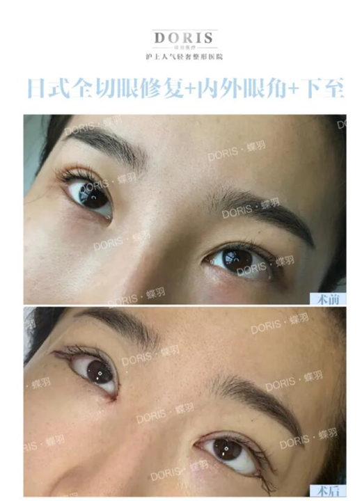 开外眼角的黄金搭档一眼脸下至