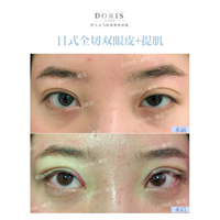 居然还有人说大小眼就是双眼皮宽窄导致的