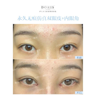 双眼皮黄金搭档开眼角