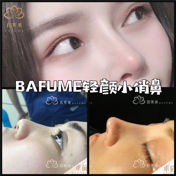 西安鼻整形医生推荐 