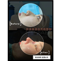 陈军宝异体鼻综合术后即刻 