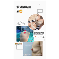 上海假体隆胸整形 