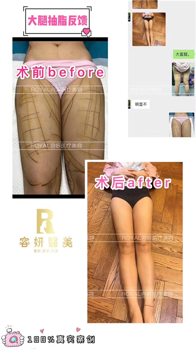 上海大腿吸脂整形 