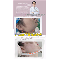 张铉磨骨整形专家