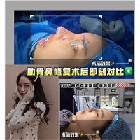 上海肋骨鼻整形修复