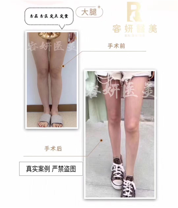 上海大腿吸脂价格 