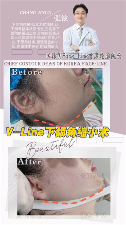 张铉磨骨整形专家