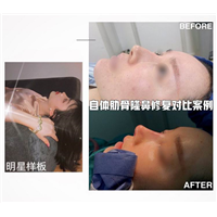 上海肋骨鼻整形修复