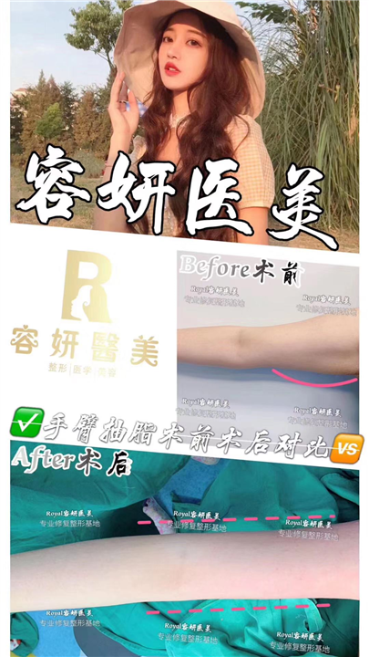上海手臂吸脂 
