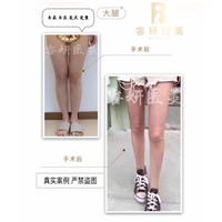 上海大腿吸脂价格 