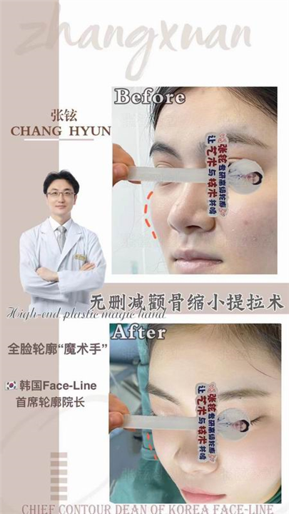 张铉磨骨整形专家