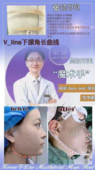 张铉磨骨整形专家