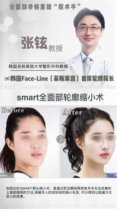 张铉磨骨整形专家