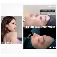 上海肋骨鼻整形修复