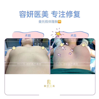 上海假体隆胸价格 
