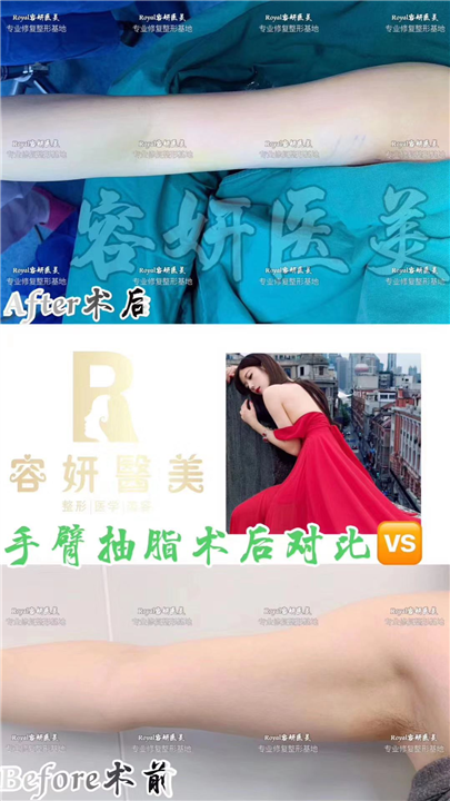 上海抽脂整形哪家专业 