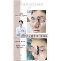 张铉磨骨整形专家