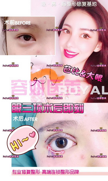 上海脂肪隆胸整形