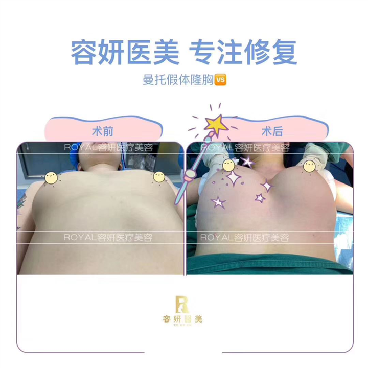上海假体隆胸价格 