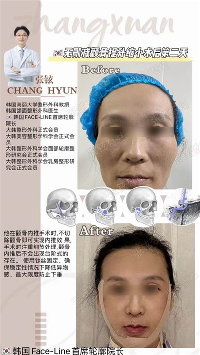 张铉磨骨整形专家