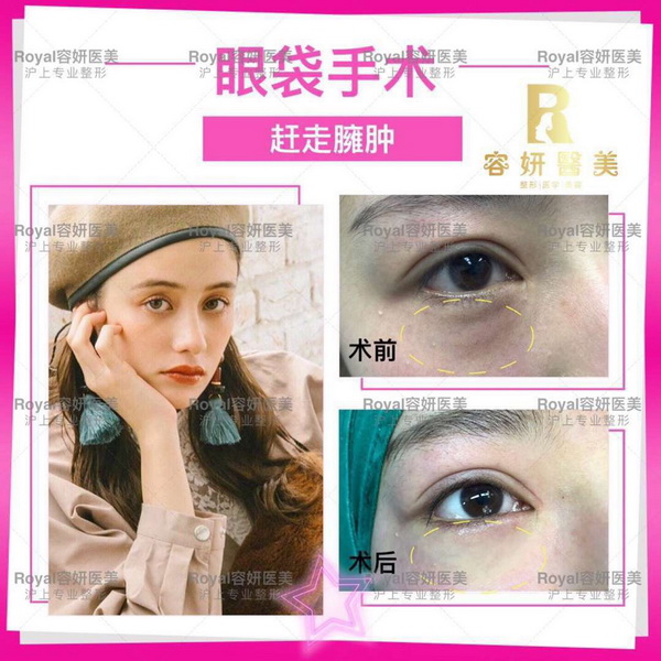 上海脂肪隆胸整形 
