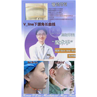 张铉磨骨整形专家