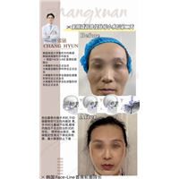 张铉磨骨整形专家