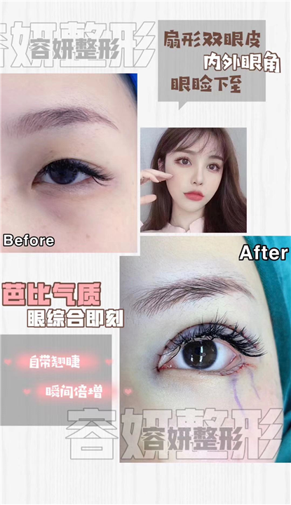 上海眼综合整形 