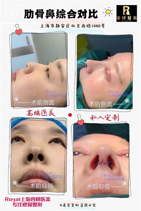 上海鼻综合整形哪家好 