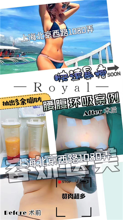 上海腰腹吸脂 