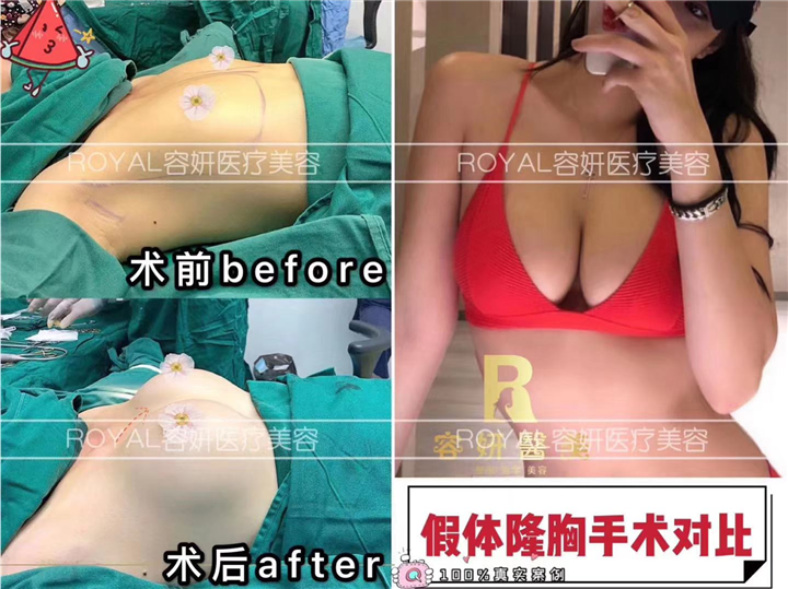 上海隆胸整形哪家好 