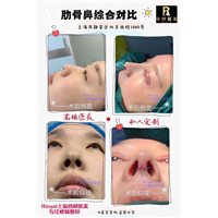 上海鼻综合整形哪家好 