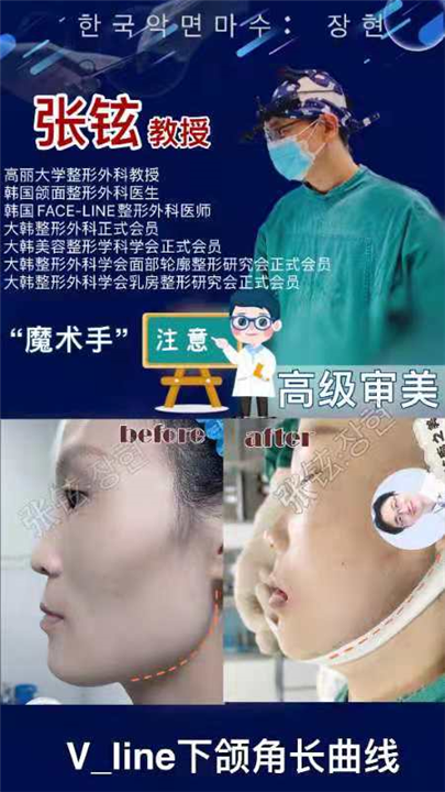 张铉磨骨整形专家