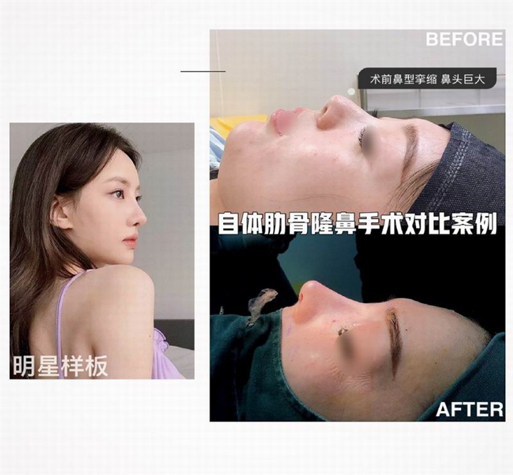 上海肋骨鼻整形修复