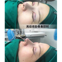 上海肋骨鼻整形修复