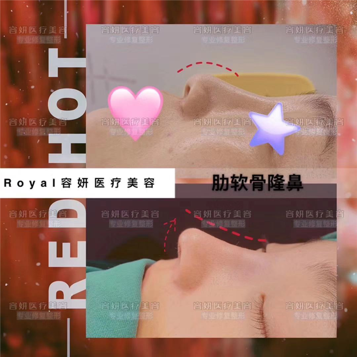 上海鼻综合整形 