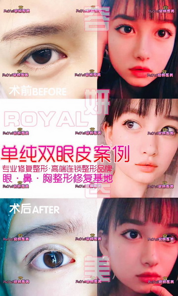 上海脂肪隆胸整形 