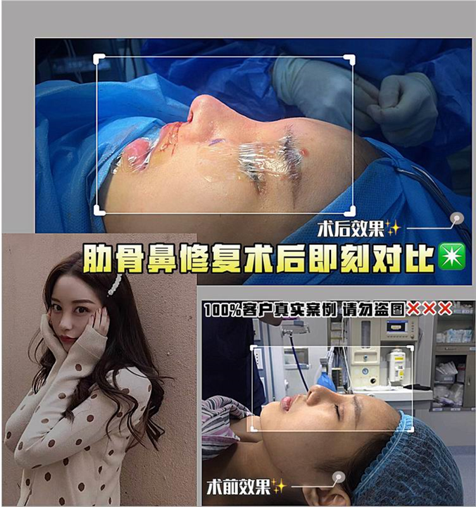 上海肋骨鼻整形修复