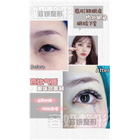 上海眼综合整形 