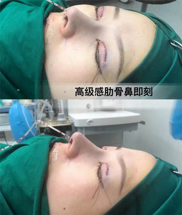 上海肋骨鼻整形修复