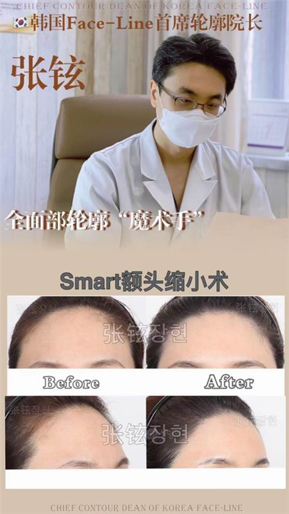 张铉磨骨整形专家