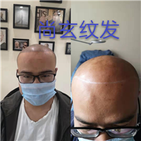 山东客户纹发前后