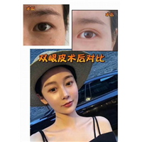 沈阳做双眼皮哪家好｜沈阳鼻部整形哪家好