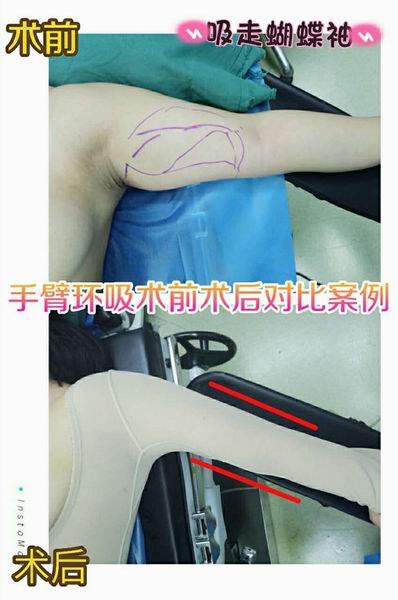 沈阳鼻综合整形｜沈阳做双眼皮哪家好