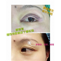 沈阳眼综合整形｜沈阳网红整形医院
