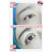 沈阳眼综合整形｜沈阳网红整形医院
